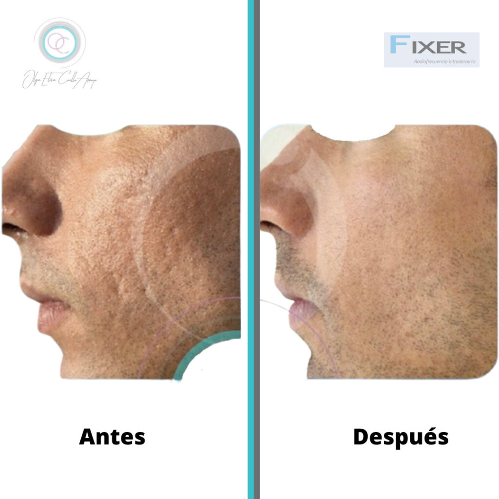 Fixer Tecnología de punta Dra Olga Elisa Cuello Arroyo Cirugía Plástica Bucaramanga Colombia