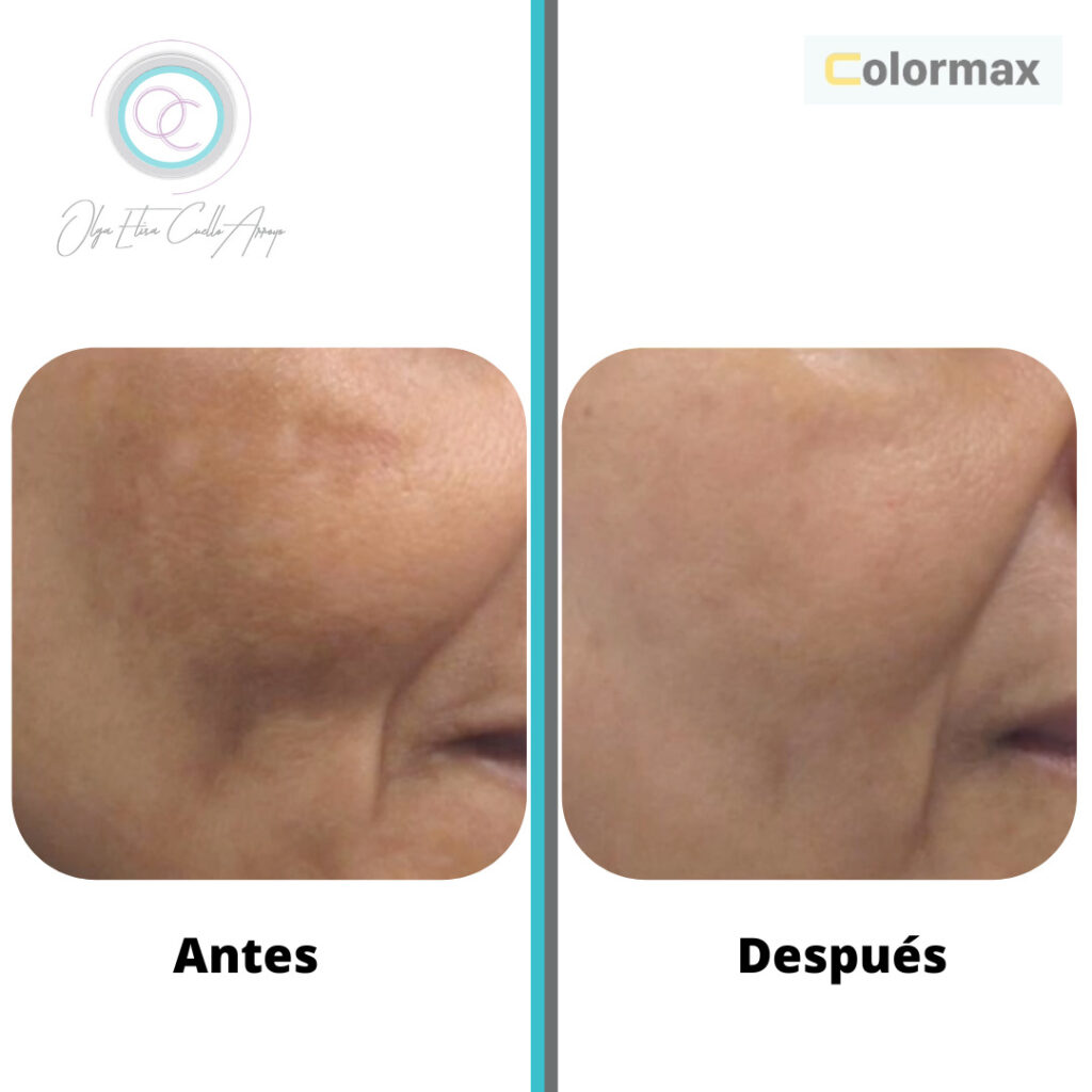Colormax Tecnología de punta Dra Olga Elisa Cuello Arroyo Cirugía Plástica Bucaramanga Colombia
